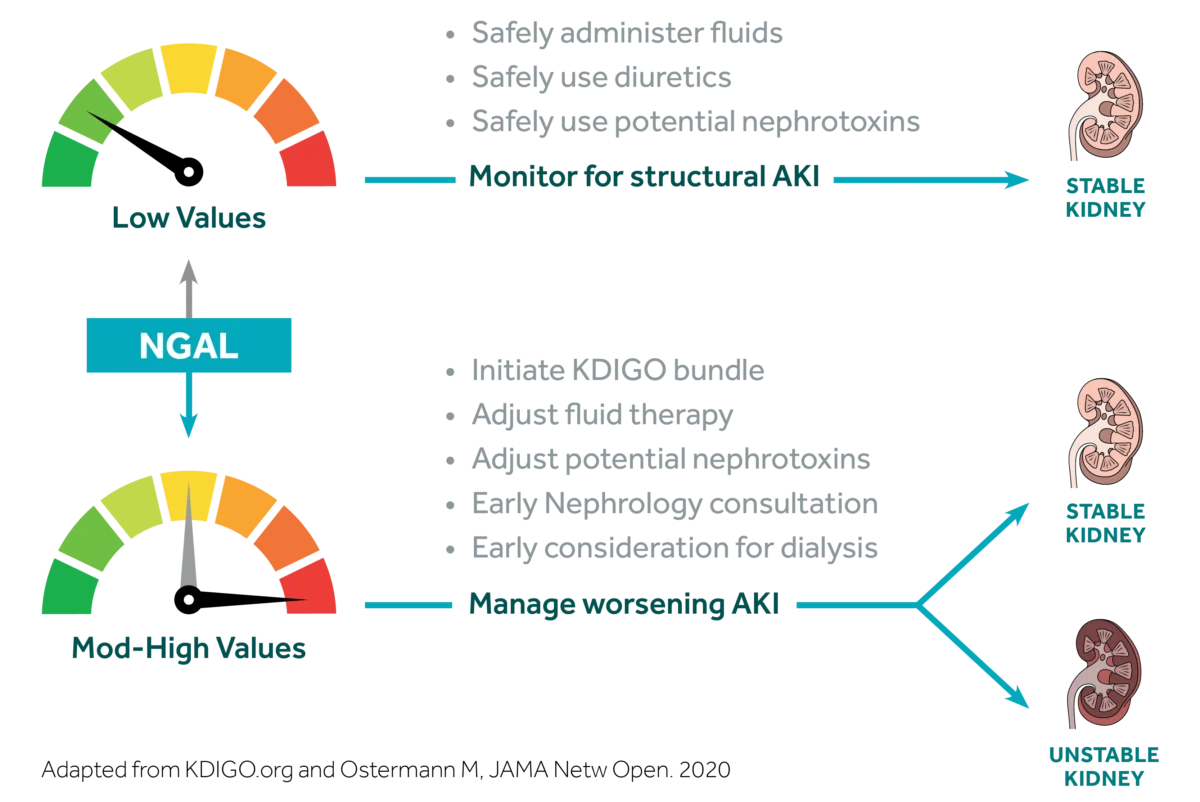 Infographic showing NGAL levels guiding treatment for AKI: low values indicate monitoring and safe fluid/nephrotoxin use, while high values suggest intensive management to prevent worsening AKI.